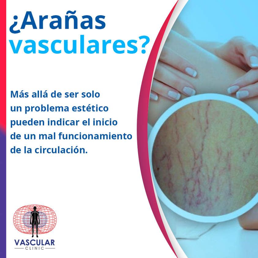 Arañas Vasculares